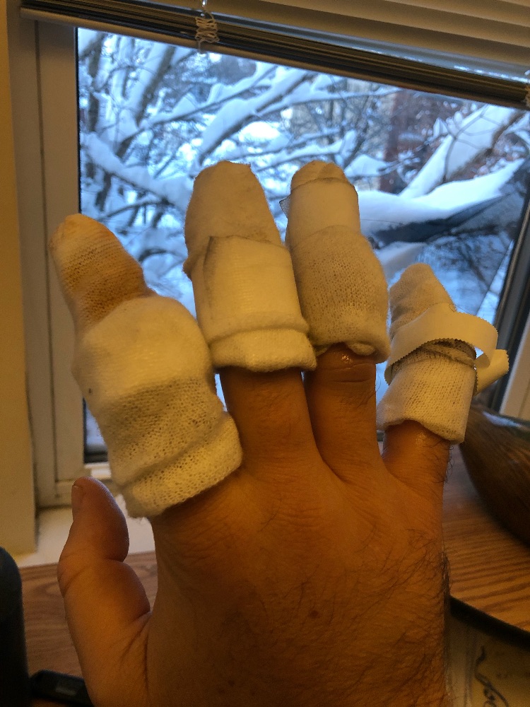 skiing frostbite fingers